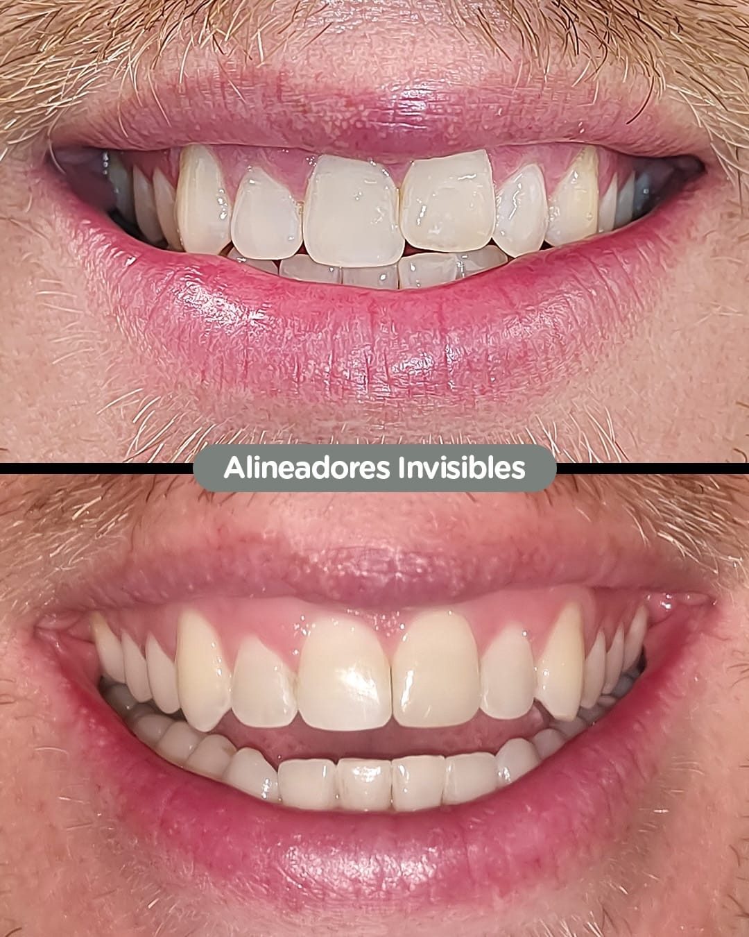 Resultado de Invisalign en Dental Group Panama