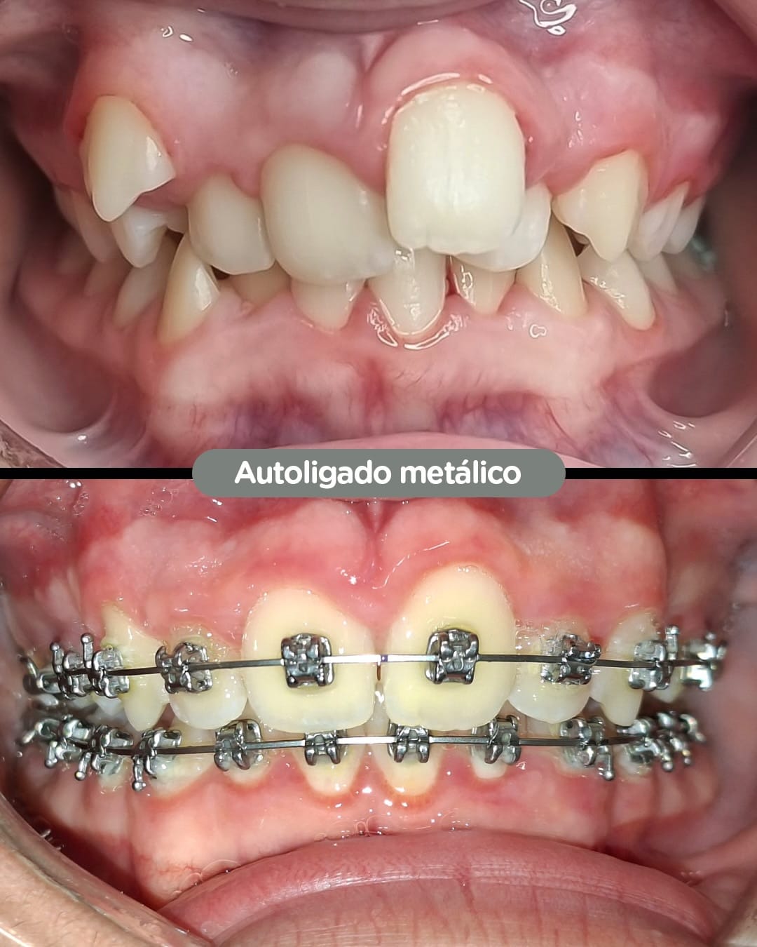 Caso de Brackets autoligados en Dental Group Panama