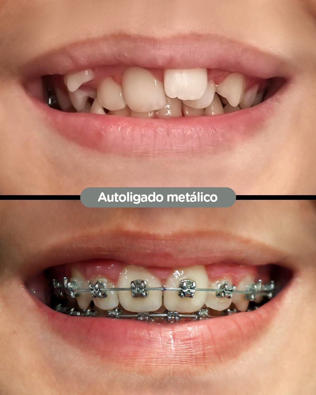 Brackets estéticos