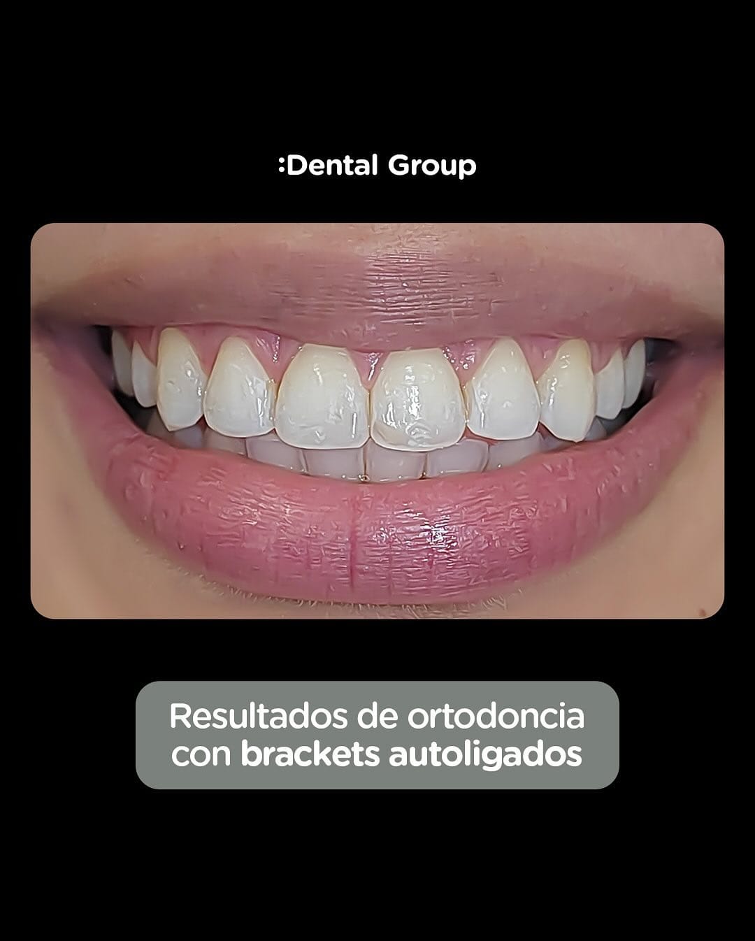Resultado de Retenedores dentales en Dental Group Panama