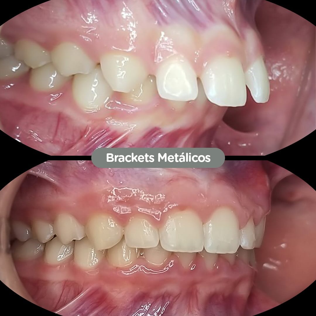 Brackets metálicos