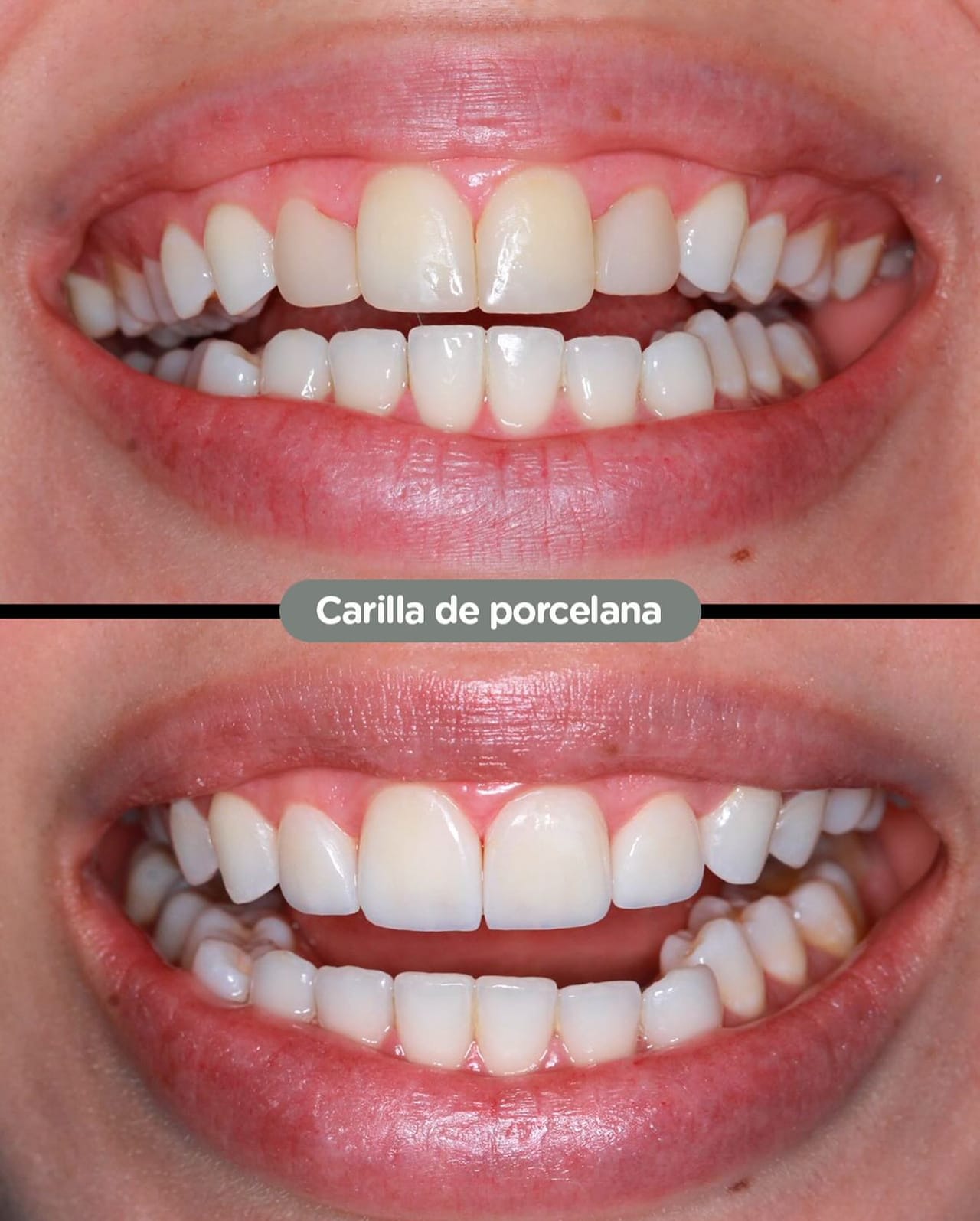 Resultado de Prótesis fija en Dental Group Panama