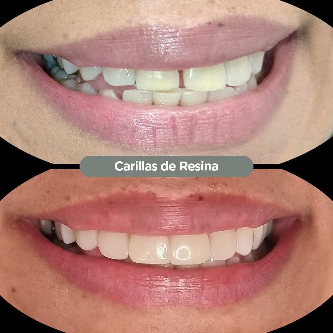 Carillas de resina