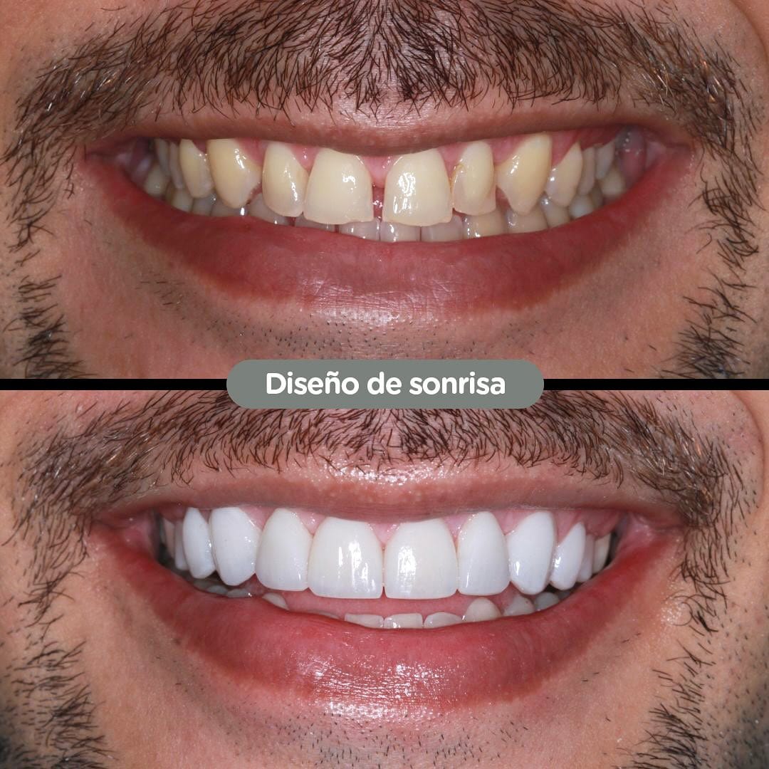 Resultado de Diseño de sonrisa en Dental Group Panama