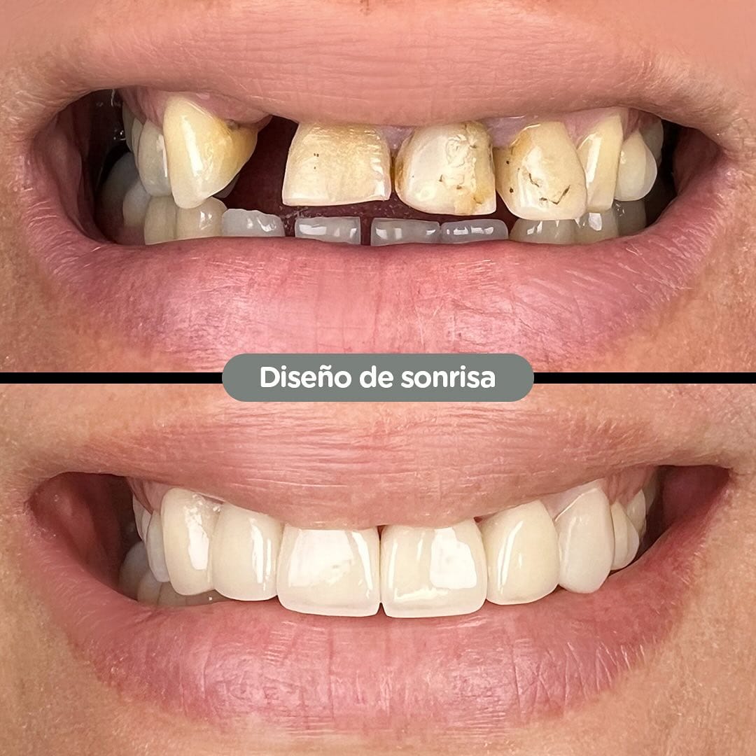 Caso de Diseño de sonrisa en Dental Group Panama