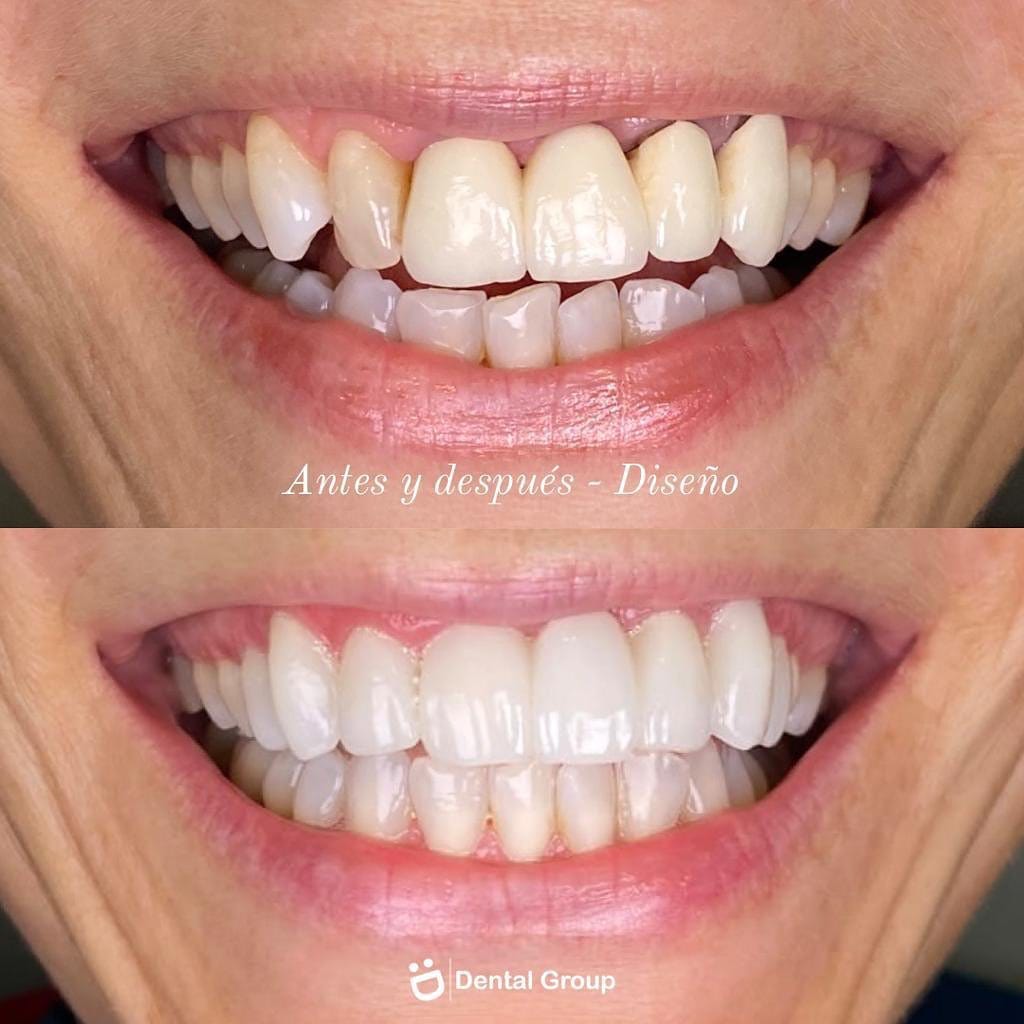 Caso de Diseño de sonrisa en Dental Group Panama