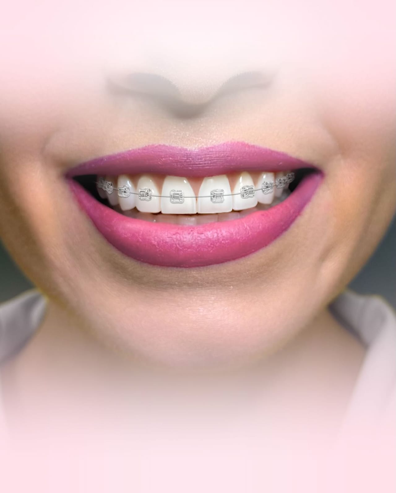 Caso de Diseño de sonrisa en Dental Group Panama