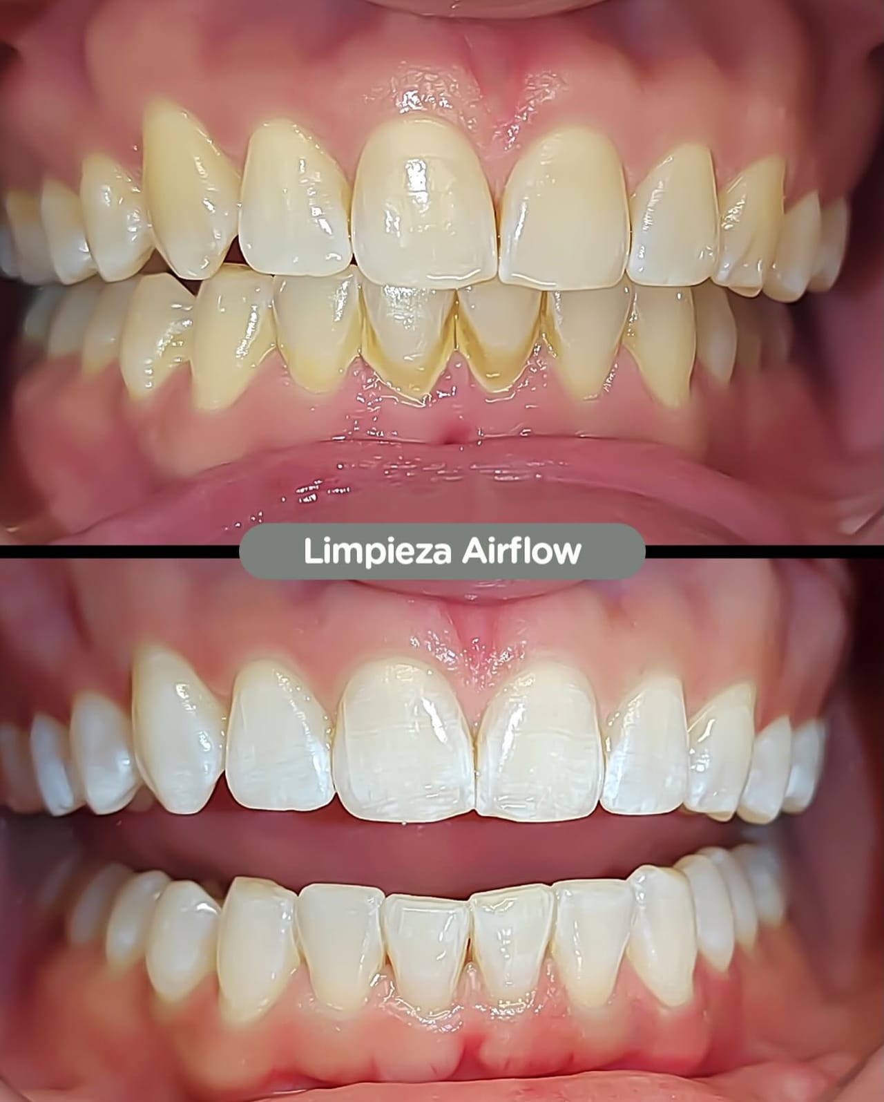 Resultado de Limpieza dental Airflow en Dental Group Panama