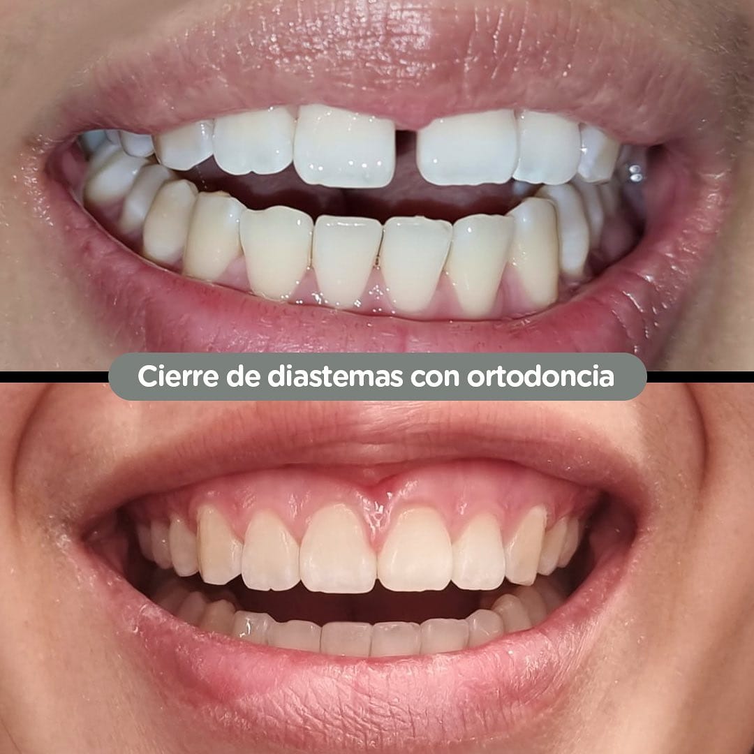 Resultado de Ortodoncia en Dental Group Panama